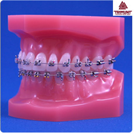 Orthodontics Model with ceramic brackets, metal tubes andn NiTi wires are white coated